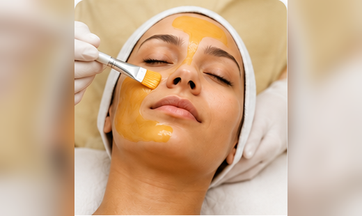 Chemical Peel